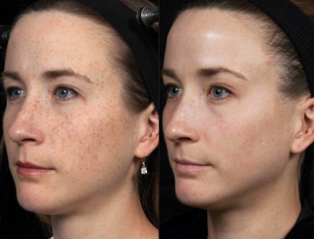 Where Can I Find Expert Laser Skin Resurfacing Services in Torrance