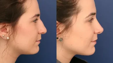 Nose Surgery