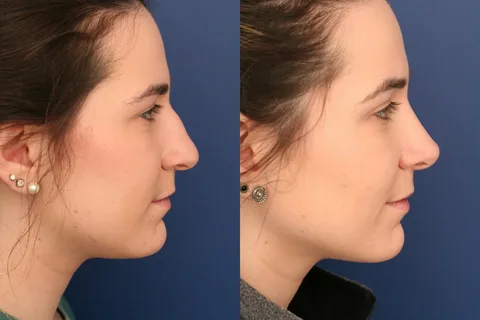 Nose Surgery