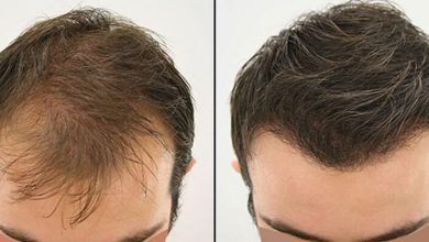 Factors That Affect Hair Growth After Hair Transplant